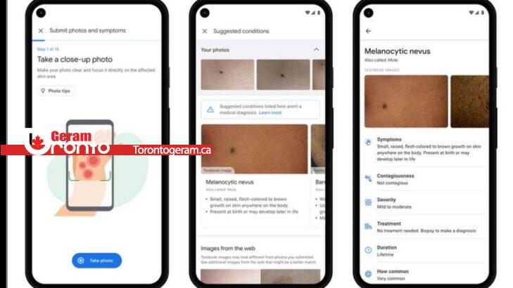 گوگل از هوش مصنوعی برای تشخیص بیماری‌های پوست رونمایی کرد